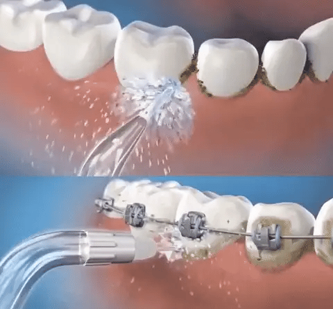 IRRIGADOR BUCAL CON 4 BOQUILLAS®