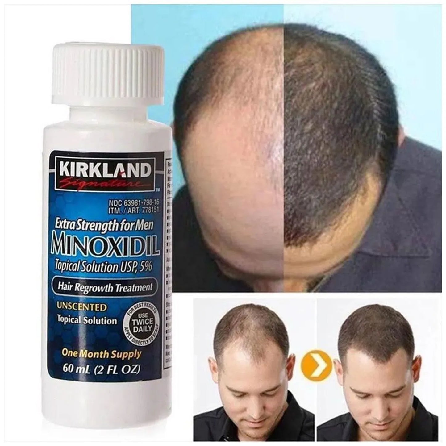 TRATAMIENTO MINOXIDIL 6 MESES®