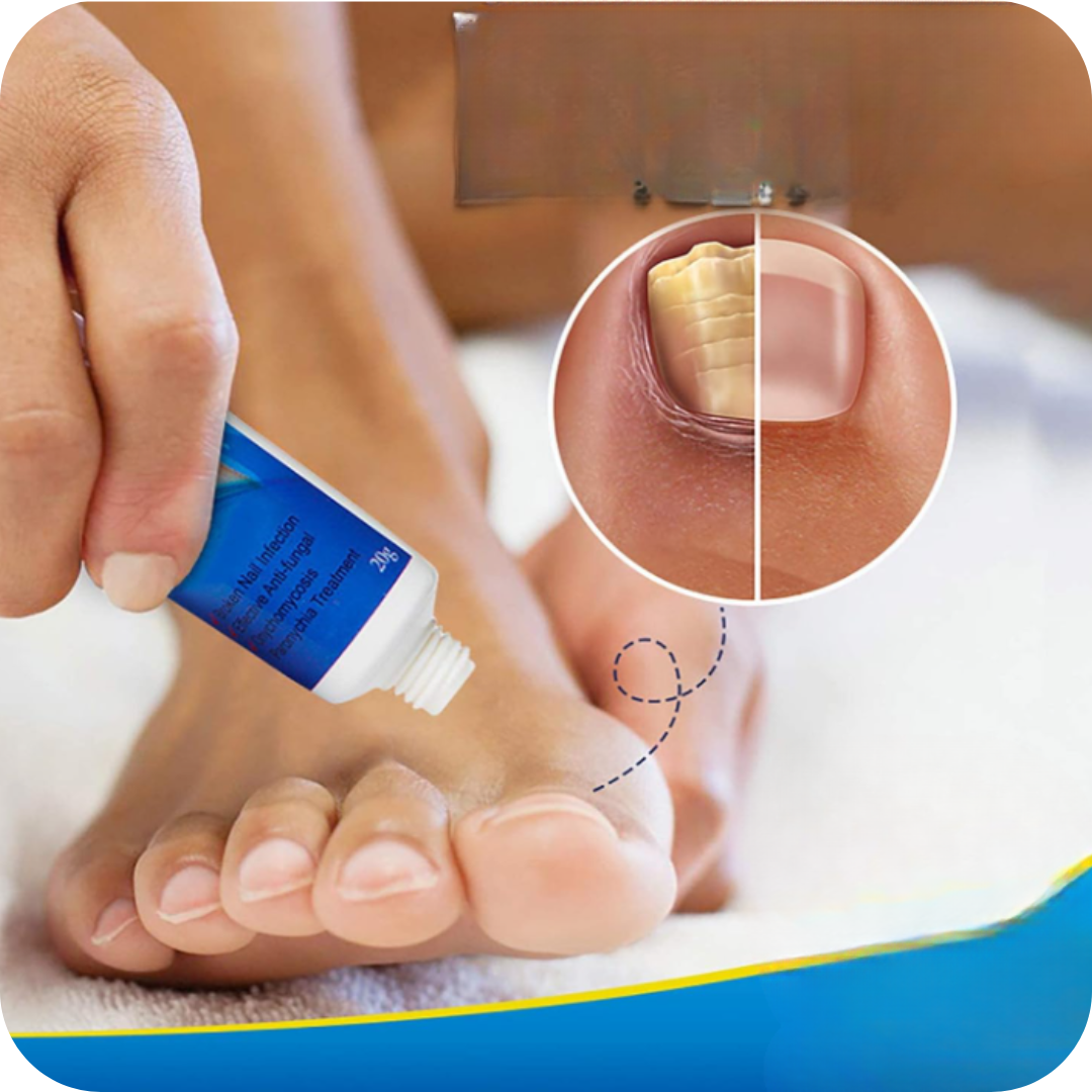 Nail Fungus Pro® Crema Anti Hongos para los Pies