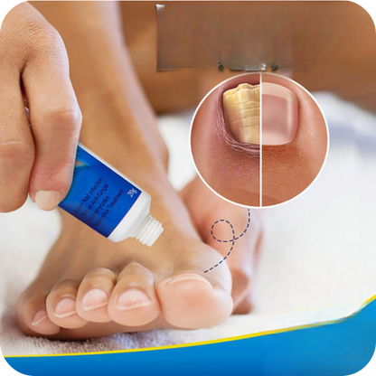 Nail Fungus Pro® Crema Anti Hongos para los Pies